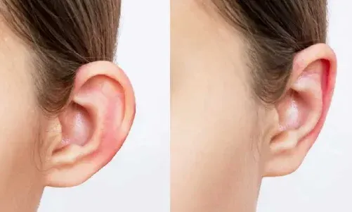 Before and After Results 1