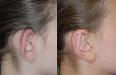 Before and After Results 2