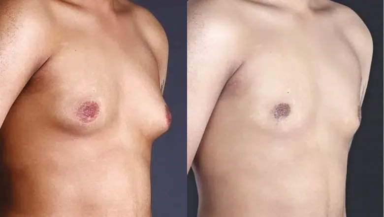Before and After Results 1